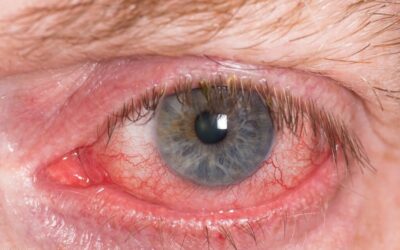 Red irritated eye Almost open red and irritated eye with blood vessels